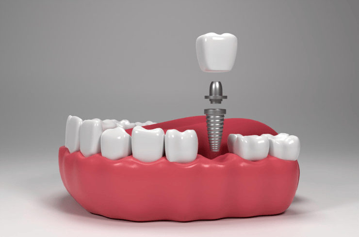 Dental Implants